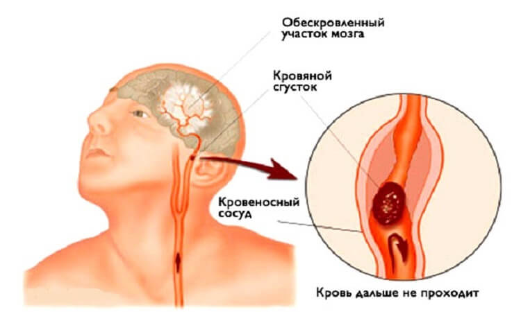 Инсульт: Всего 3 первых шага, чтобы спасти себе и близким жизнь!