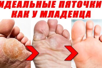 Гладкие пяточки. Что бы не трескались пятки испробуй этот рецепт. Может помочь.