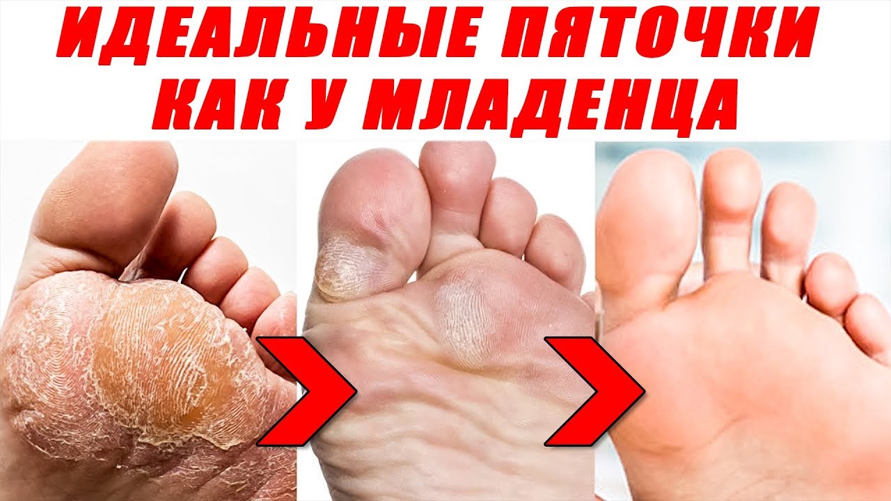 Гладкие пяточки. Что бы не трескались пятки испробуй этот рецепт. Может помочь.