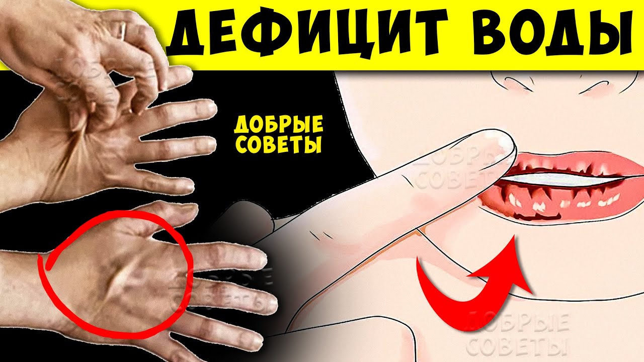10 тревожных признаков Дефицита Воды в организме! Кто в зоне Риска