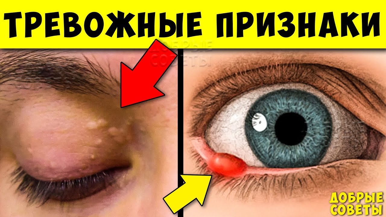 Серьёзные признаки Опасных заболеваний по Глазам! Не Игнорируй их...