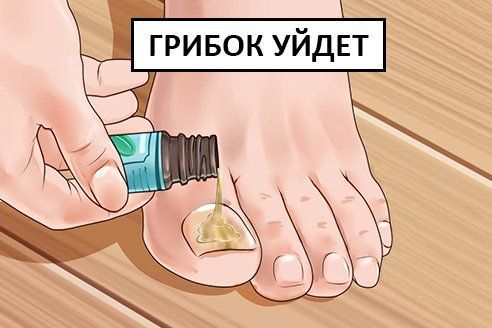 Народные методы лечения грибковых инфекций на ногтях: 7 лучших рецептов