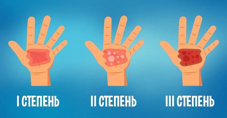 Первая помощь при бытовых ожогах кипятком, паром, кипящим маслом и кислотой