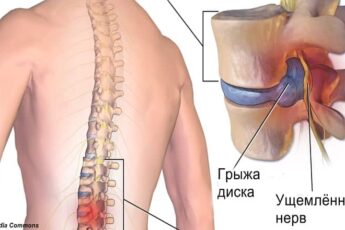 Хирург отговорил меня от операции и посоветовал делать эту зарядку! И ведь помогло!