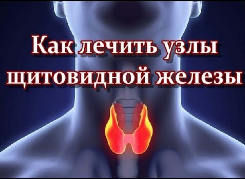 Народное лечение узлов щитовидной железы. Излечение узлов щитовидной железы.