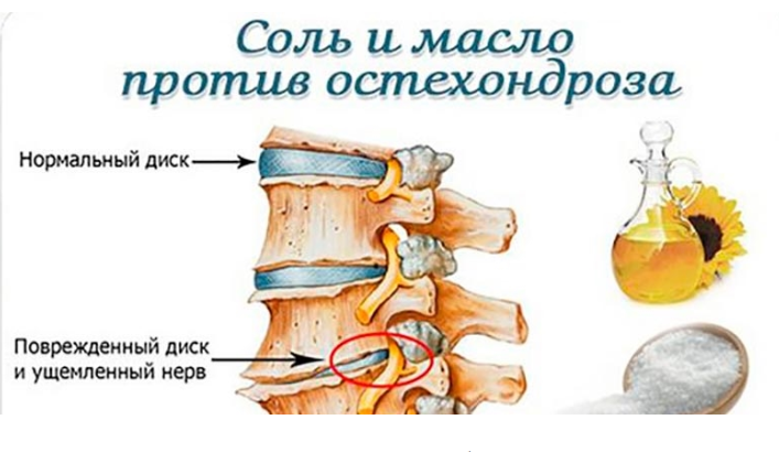 Остеохондроз соли. Отложение соли в позвоночнике. Соль и масло против остеохондроза. Отложение солей в позвоночнике симптомы.