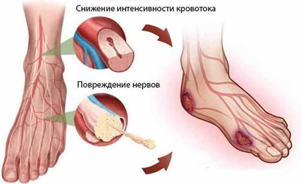 Мужа-диабетика спас простой рецепт из газеты!