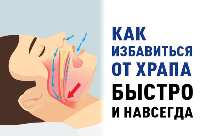 Как избавиться от храпа быстро и навсегда