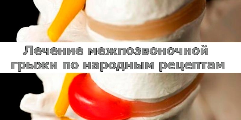 Лечение межпозвоночной грыжи по народным рецептам