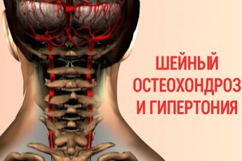 Гипертония и инсульт — последствия шейного остеохондроза! Это можно предотвратить выполняя лечебный комплекс!