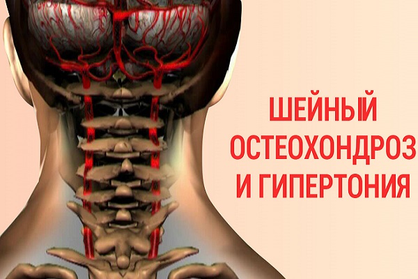 Гипертония и инсульт — последствия шейного остеохондроза! Это можно предотвратить выполняя лечебный комплекс!