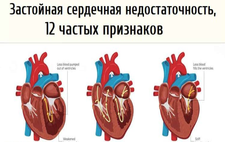 Недостаточность по большому кругу. Застойная сердечная недостаточность.