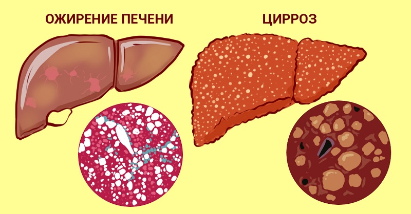 А что, если печень можно вылечить травами. 5 проверенных тысячами людей рецептов