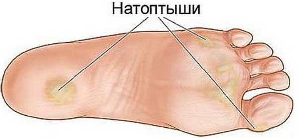 Простые и действенные рецепты для устранения трещин, натоптышей, варикоза, сосудистой сетки