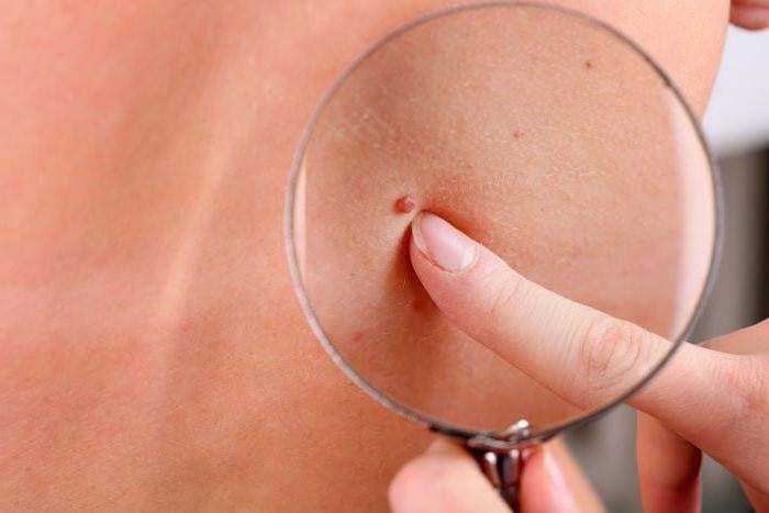 Как избавиться от папиллом в домашних условиях