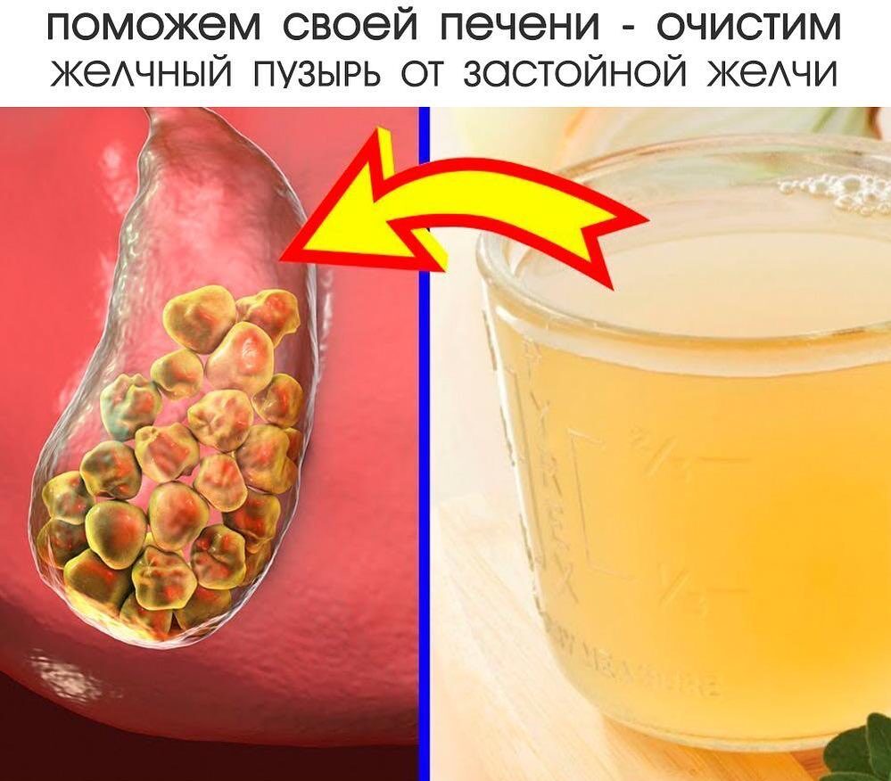 Вода при камнях в желчном. Сок для очищения желчного пузыря. Очищение печени и желчного пузыря. Лимон для желчного пузыря. Медовая вода от камней в желчном пузыре.