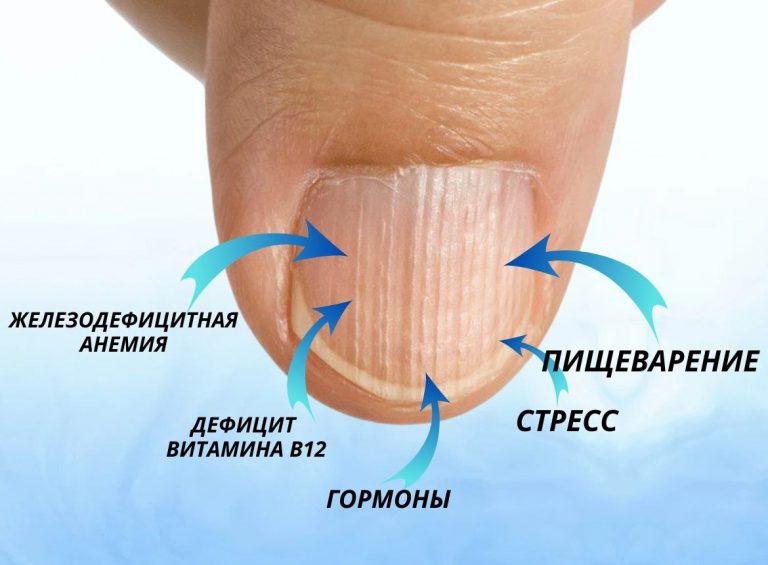 Почему на ваших ногтях появляются вертикальные полосы: 6 причин, о которых стоит знать