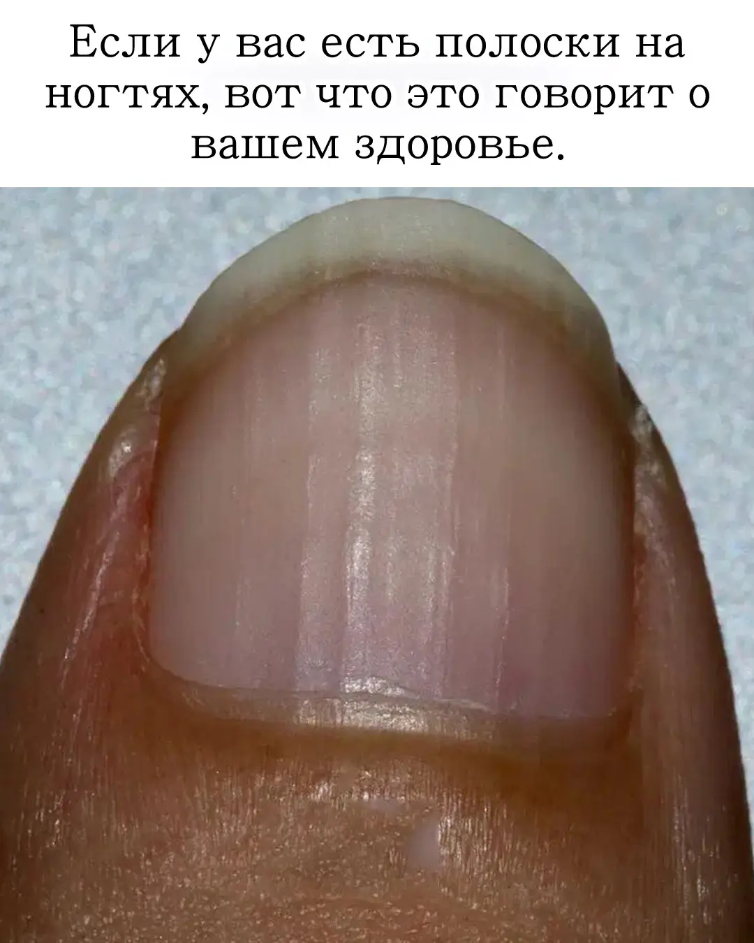 Если у вас бороздки на ногтях, вот что это говорит о вашем здоровье